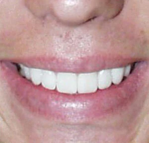 After treatment, case 1