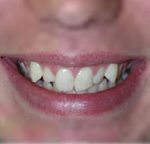 Before treatment, case 1