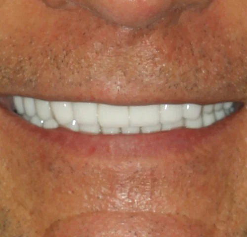 A patient's smile after treatment