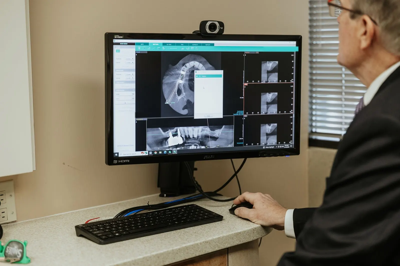 A 3D cone beam scan on a monitor, used to plan implant placement
