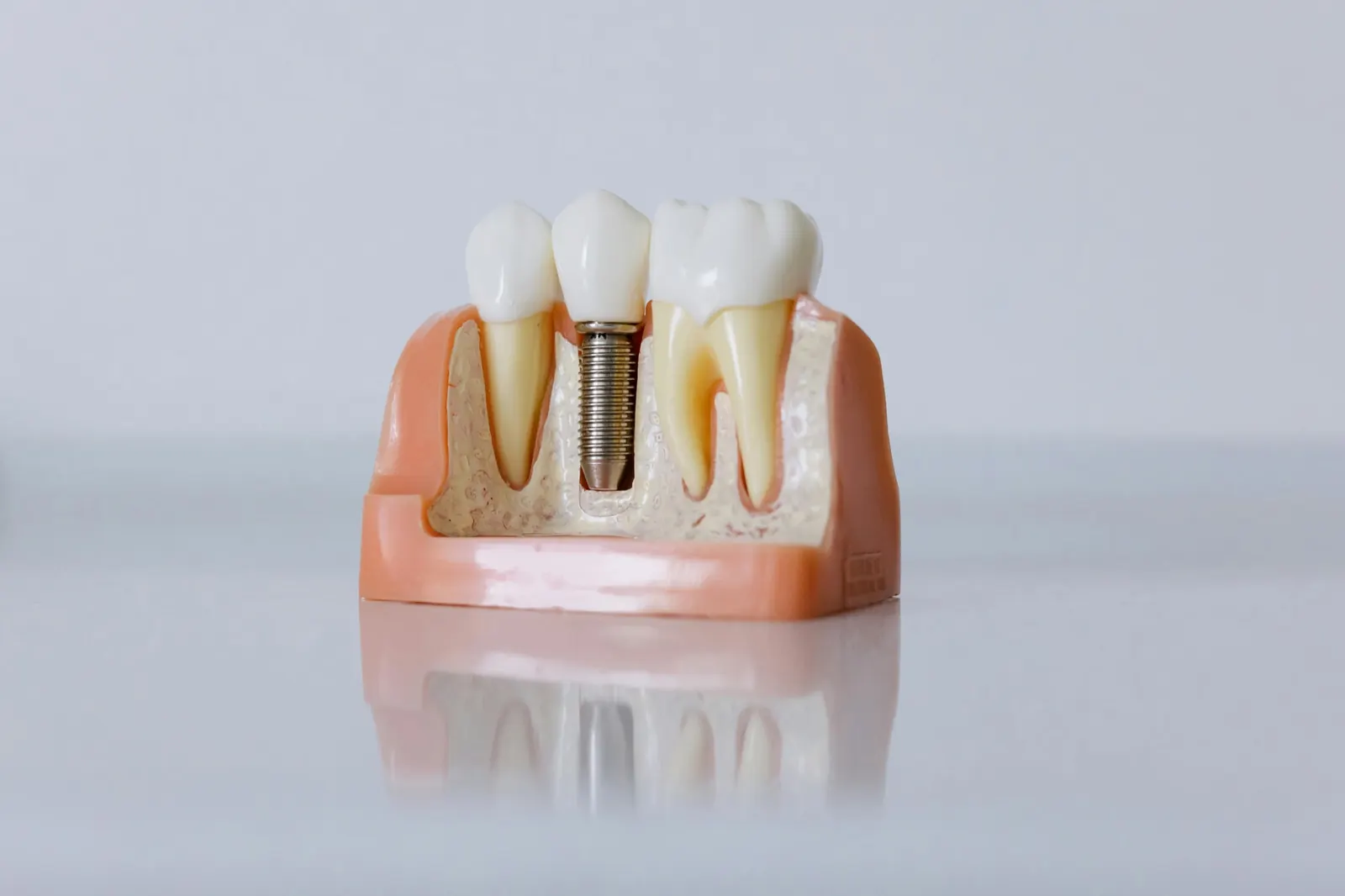 A model showing a dental implant set into the jawbone