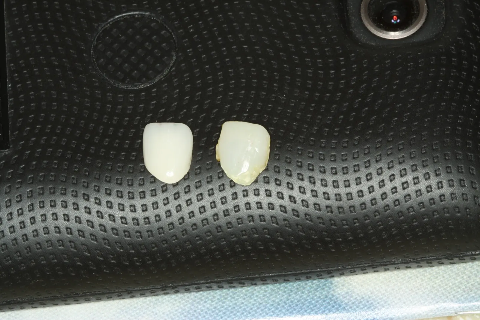 Custom porcelain restorations laid out on a tray