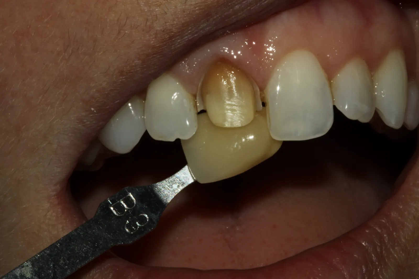 Matching a tooth shade before bonding
