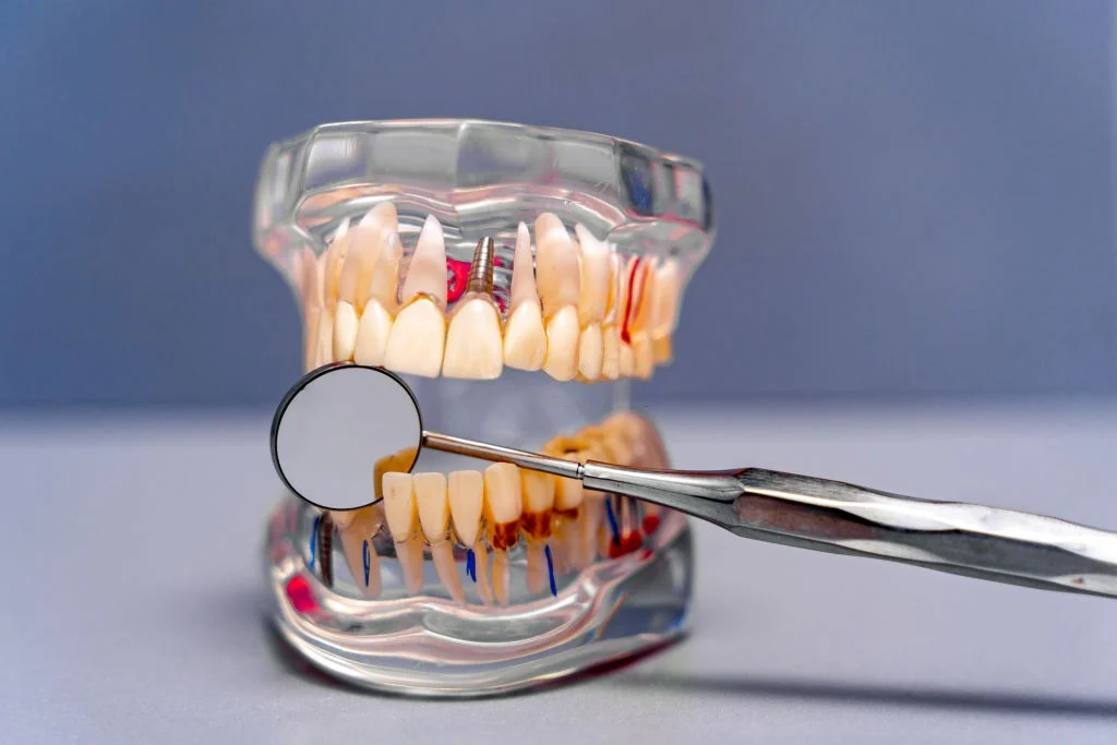 Full Mouth Dental Implants
