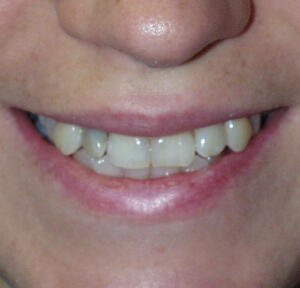 Before