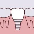 Dental Implants in Baltimore, MD