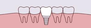 dental implants Timonium