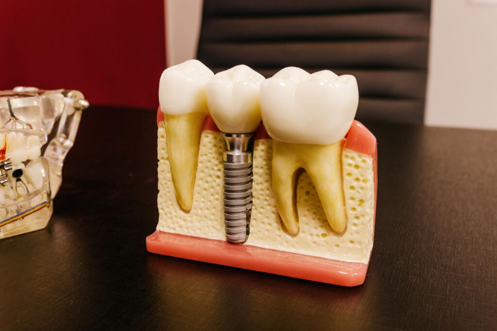 dental implant bridge Timonium MD