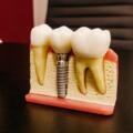 Dental Implant Bridge Timonium MD: 7 Amazing, Smart Benefits